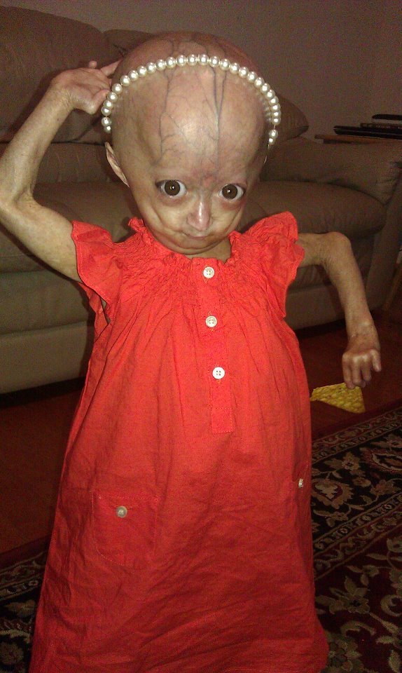 Adalia Rose Williams trpí nemocí, kvůli které stárne několikrát rychleji, než ostatní