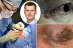 Ječné zrno u oka? Hrozí i nádor, varuje lékař a radí, jak jej rozpoznat
