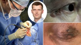MUDr. Adam Kopecký operuje nádory očních víček a radí lidem: Noste sluneční brýle.
