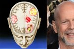 Bruce Willis trpí afázií