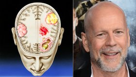 Problém s mluvením i psaním: Co je afázie, kterou trpí Bruce Willis, a jaké jsou možnosti léčby?