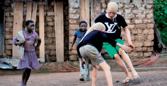 Africké předpeklí albínů
