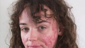 Mariah Pearsonová (20) trpí extrémním akné