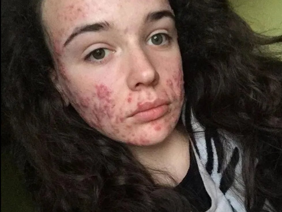 Mariah Pearsonová (20) trpí extrémním akné