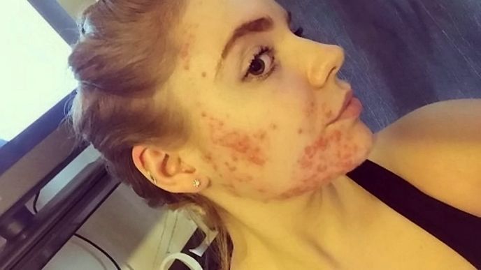 Rachel Crawleyové zanechalo akné na obličeji i bradě děsivé jizvy. Jenže šikovná dívka se nenechala psychicky zničit. 