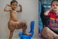 Chlapeček (3) trpí vzácnou nevyléčitelnou chorobou: Jeho noha je den ode dne větší