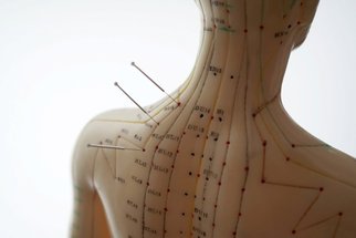 Akupunktura se využívá nejen k léčbě, ale také diagnostice a prevenci