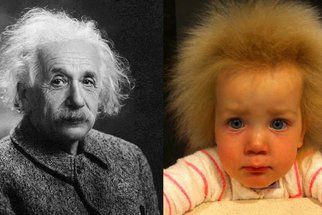 Neuvěřitelné! Holčička trpí stejným syndromem jako Albert Einstein! 