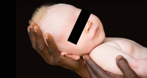 V Tanzanii zabili roční albínské batole. Na přípravu lektvaru štěstí