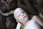 Fotografie albínů ze série snímků "Pod stejným sluncem"
