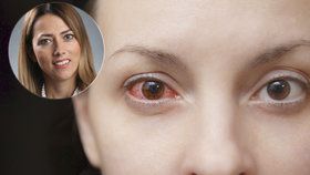 V momentě, kdy se alergeny dostanou do očí, způsobí podráždění oční spojivky, která se zanítí.