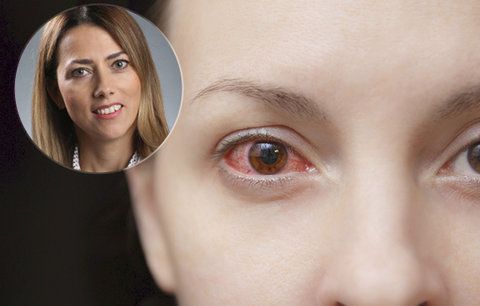 Lékařka varuje před rizikem očních alergií: Neléčený zánět vede k vážným komplikacím 