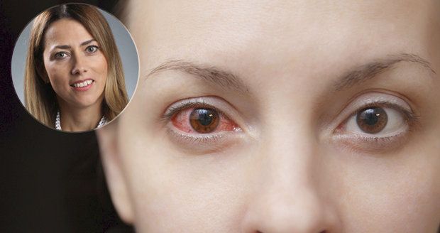 V momentě, kdy se alergeny dostanou do očí, způsobí podráždění oční spojivky, která se zanítí.