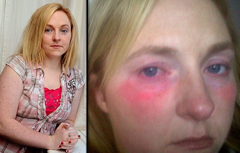 Žena (26) má alergii na vodu: Nesmí se ani rozplakat