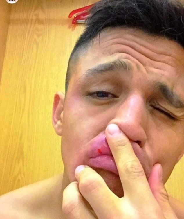 Hvězdný útočník Alexis Sánchez po zápase s Leicesterem ukázal malý šrám