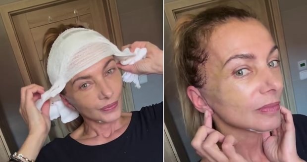 Alice Bendová po náročné operaci: Trhali ze mě kůži!