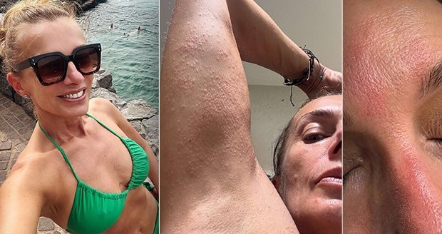 Alice Bendová a její alergie