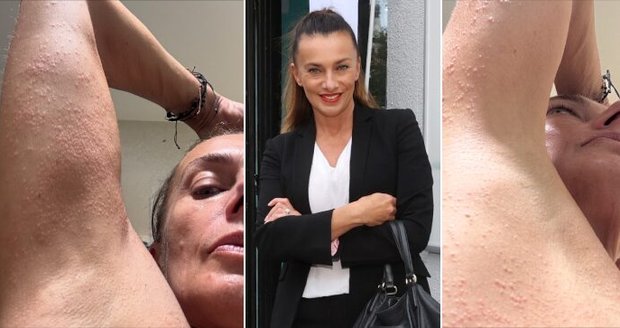 Alice Bendová ukázala příšernou vyrážku...