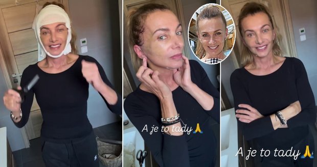Herečka Alice Bendová po liftingu obličeje a krku