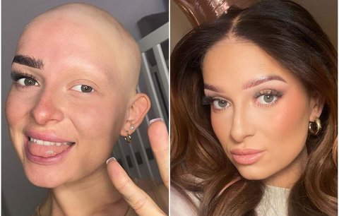 Žena trpící alopecií dva roky nevycházela ven. Dnes si obočí a paruku lepí i do postele