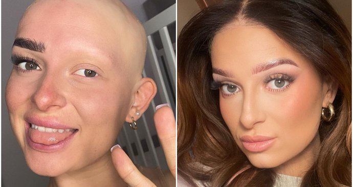 Žena trpící alopecií dva roky nevycházela ven. Dnes si obočí a paruku lepí i do postele