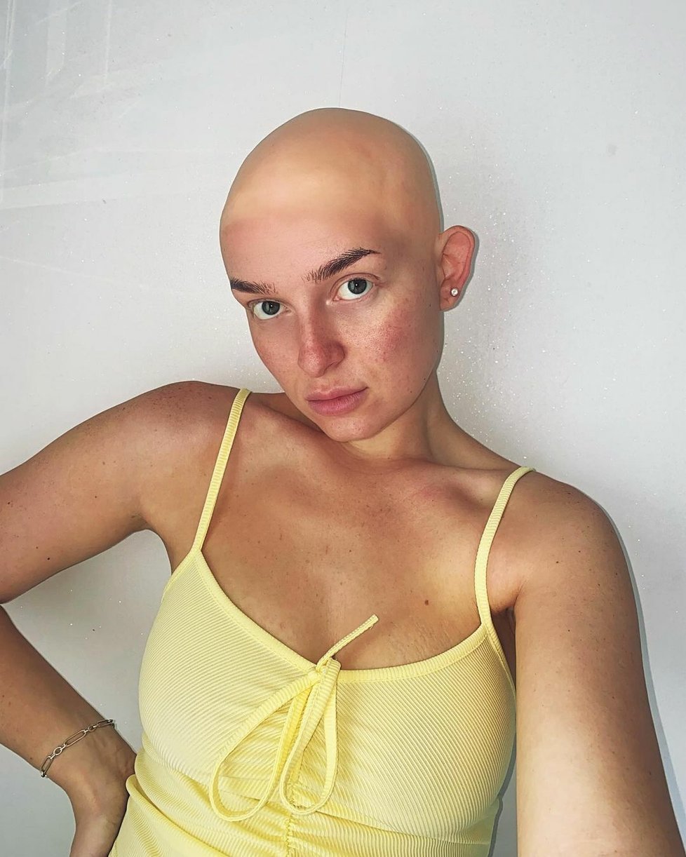 Žena trpící alopecií dva roky nevycházela ven. Dnes si obočí a paruku lepí i do postele