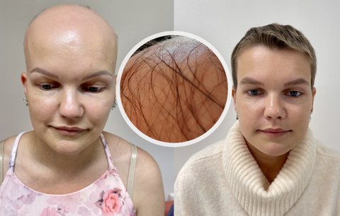Katka (28) onemocněla ze stresu a bolestivého rozchodu: Alopecie jí sebrala vlasy