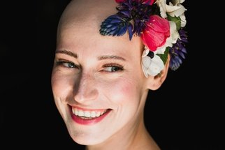 Alopecie: Problém, který trápí stále více lidí a nevyhýbá se ani známým osobnostem. Jak se projevuje a dá se vůbec léčit?