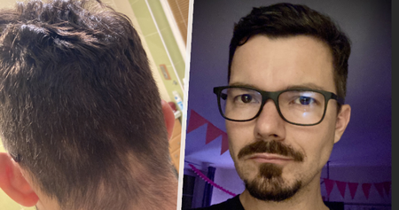 Ze stavu na fotce vlevo přišel Drahoňovský o zbytek vlasů během tří měsíců.