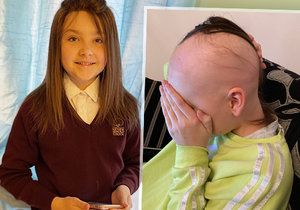 Holčička (12) pláče nad ztrátou vlasů: Kvůli alopecii je už téměř plešatá