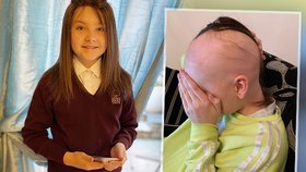 Holčička (12) pláče nad ztrátou vlasů: Kvůli alopecii je už téměř plešatá