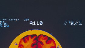 Scan mozku  pacienta s Alzheimerovou chorobou