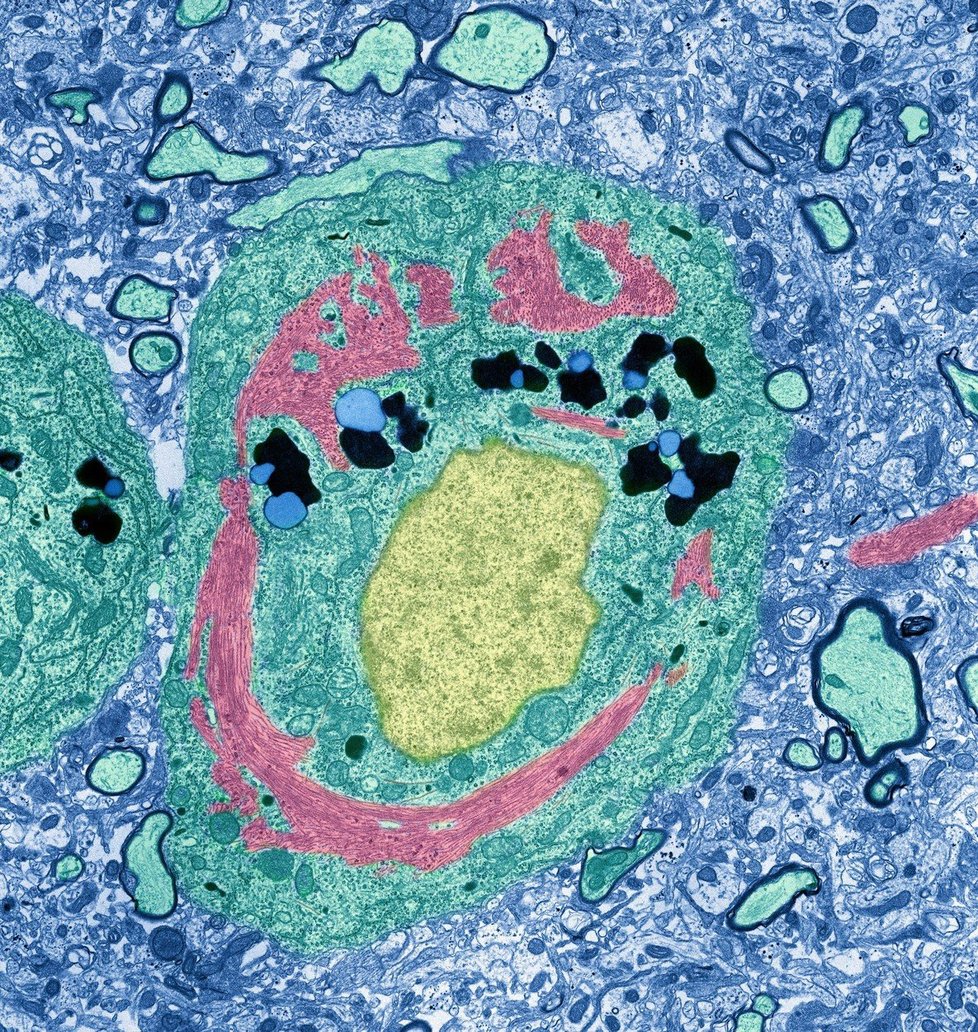 Neuron pacienta s Alzheimerovou chorobou.