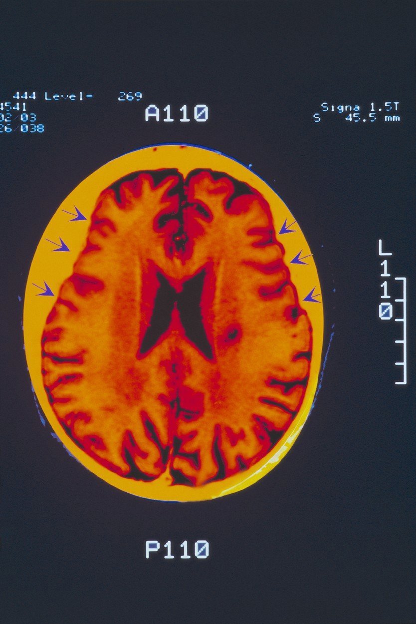 Scan mozku  pacienta s Alzheimerovou chorobou.