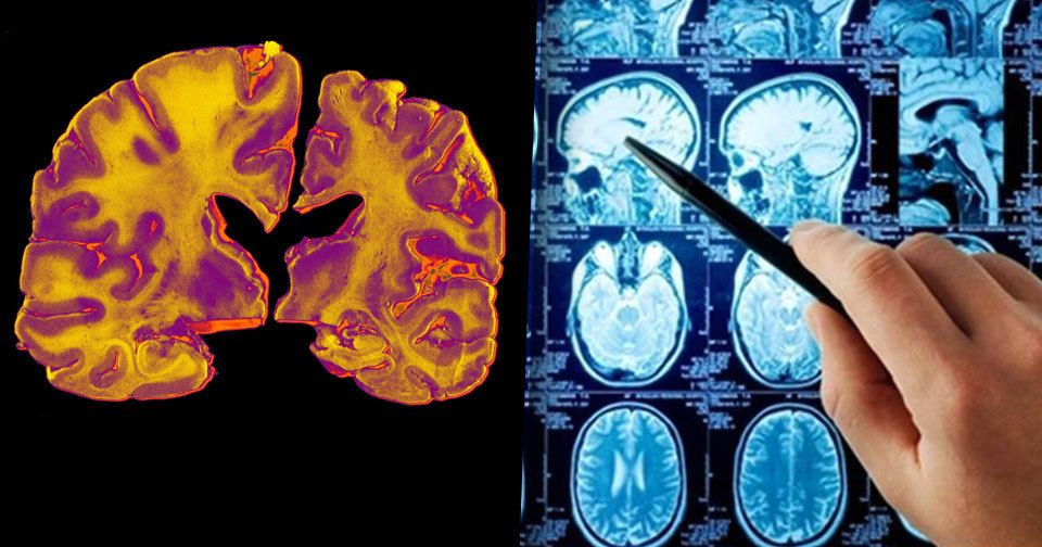 Nová léčba Alzheimerovy choroby od australských vědců! Pacientovi vrátí až 75 % paměti!