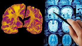 Nová léčba alzheimerovy choroby od australských vědců! Pacientovi vrátí až 75% paměti!
