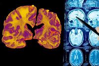 Nová léčba Alzheimerovy choroby od australských vědců: Pacientovi vrátí až 75 % paměti!