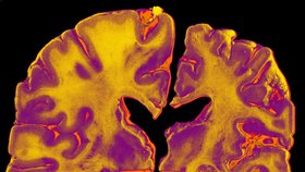 Mozek pacienta s Alzheimerovou chorobou