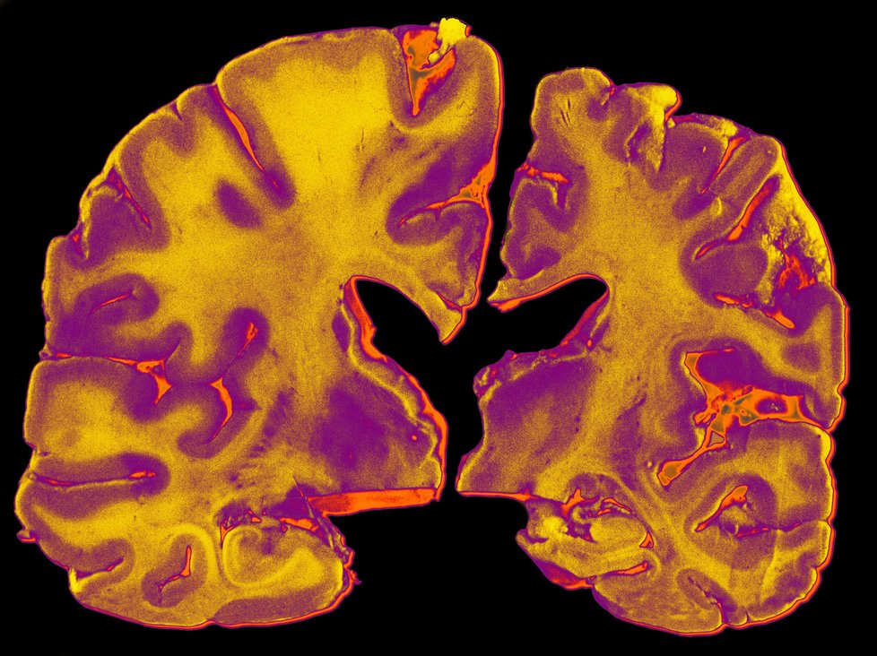 Mozek pacienta s Alzheimerem