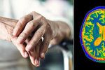 Česká alzheimerovská společnost loni v ČR evidovala 167 tisíc pacientů.