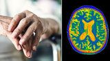 Alzheimerem trpí stále mladší lidé. Boty jim končí v troubě a mobil v lednici