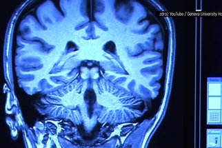 Alzheimerova choroba: Strašák ztráty paměti. Jak se projevuje a dá se léčit?