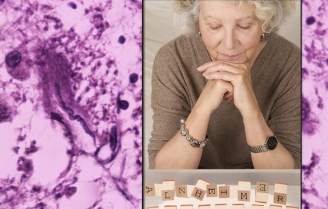 Lék proti Alzheimerově nemoci: Dostupný již za pět let? V USA věří, že ho objevili!