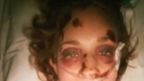 Amber Kohnhorst utrpěla v obličeji podlitiny.