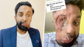 Muž (33) kvůli nádoru přišel o oko a část obličeje. Protetickou náhradou lidi šokuje i baví