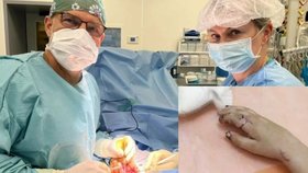 Lékaři ve FN Ostrava přišili při osmihodinové operaci amputovaný prst malému chlapci (6). Replantační výkony u dětí jsou velmi výjimečné.