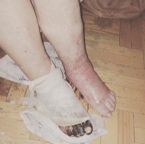 Ruská nemocnice amputovala přeživší holokaustu špatnou nohu.