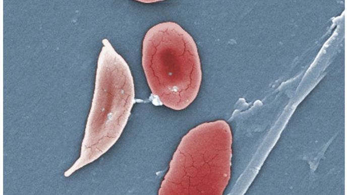 Srpkovitý tvar znemožňuje krvinkám transportovat kyslík. Zdravá (červenější) buňka má kruhový tvar a prohlubeň (pro zachycení kyslíku).