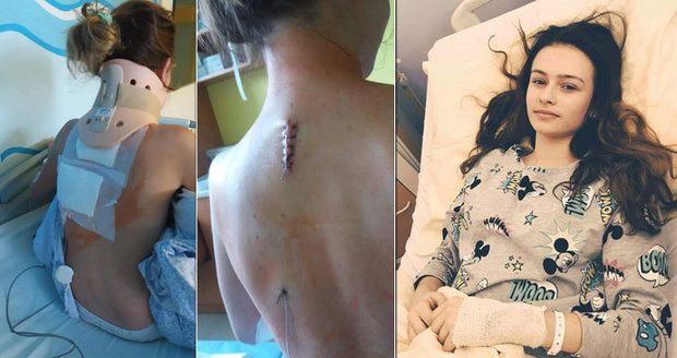 Anetě (15) po pádu v nemocnici odumírá ruka. Potřebuje operaci za 6 milionů