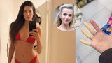Strach modelky Anety Vignerové: Děsí ji bílé prsty! Má syndrom jako Jirešová